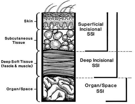 Surgical Site Infection (SSI) Classification by Depth