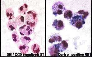 NBT test: CGD negative vs Control positive