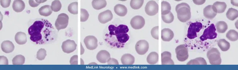 Chediak-Higashi syndrome giant granules