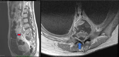 MRI spine Pott's disease with vertebral destruction