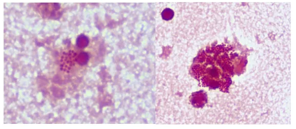 Gram stain of Neisseria gonorrhoeae in synovial fluid