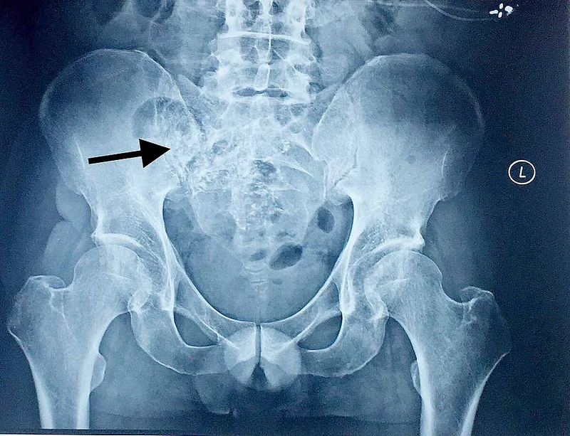 X-ray showing sacroiliitis in Brucellosis