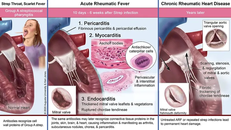 Rheumatic Heart Disease Progression