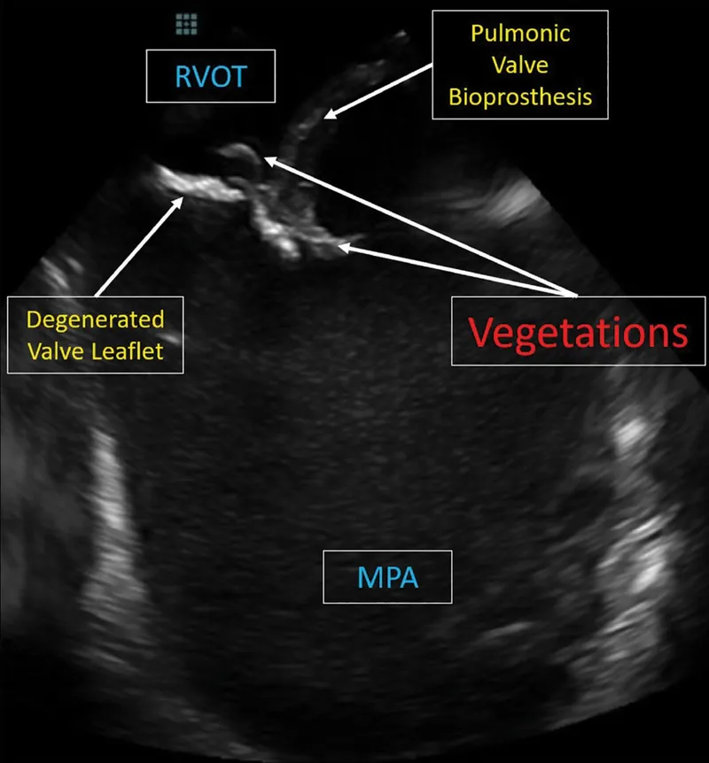 Echocardiogram: Vegetations on pulmonic valve