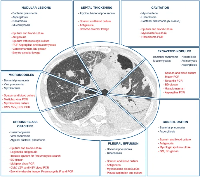 Pulmonary infections in immunocompromised hosts