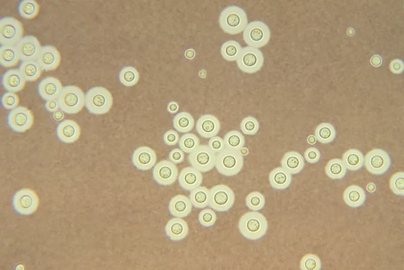 Cryptococcus neoformans with India ink stain