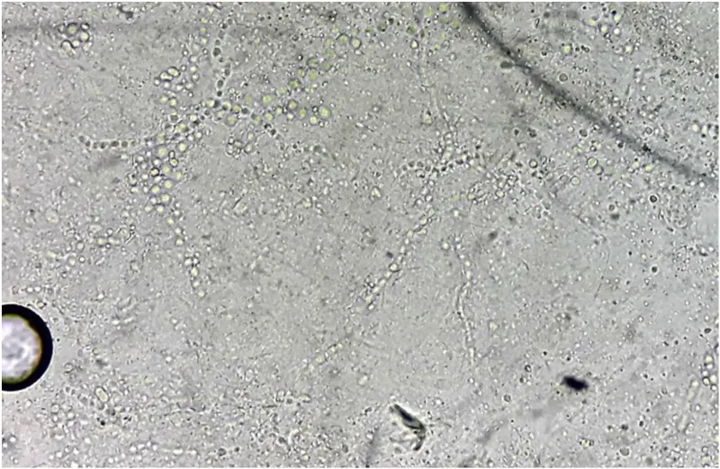 Dermatophyte hyphae and arthroconidia in KOH mount