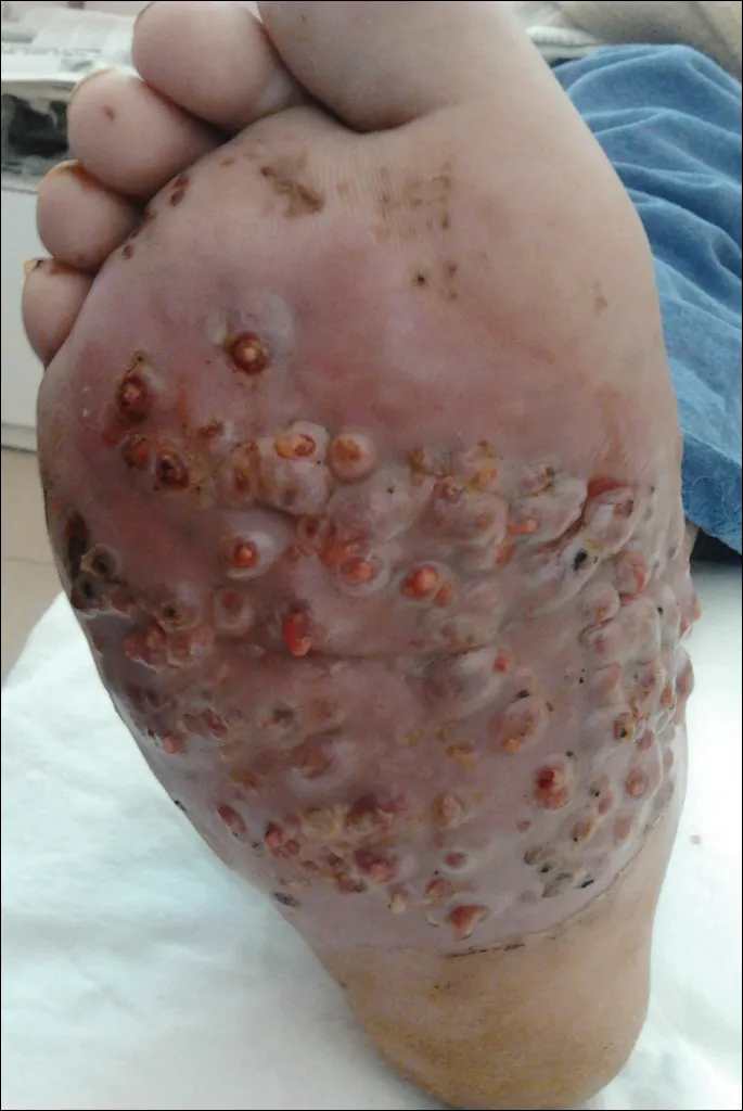Mycetoma clinical presentation on foot