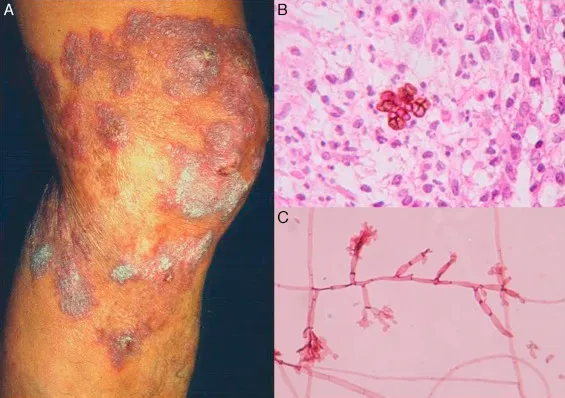 Chromoblastomycosis: Lesion, Medlar bodies, and hyphae