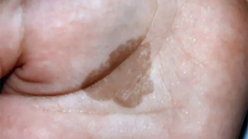 Tinea nigra palmar lesion
