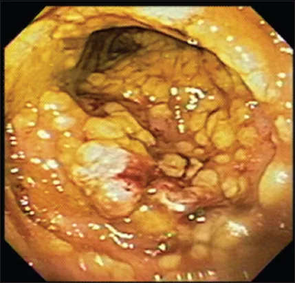 Pseudomembranous colitis on colonoscopy
