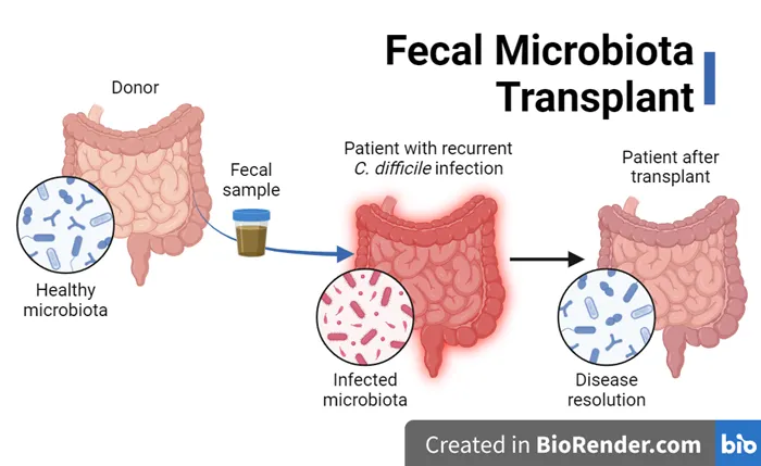 Fecal Microbiota Transplant for C. difficile Infection