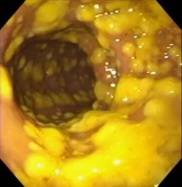 Endoscopic view of pseudomembranous colitis