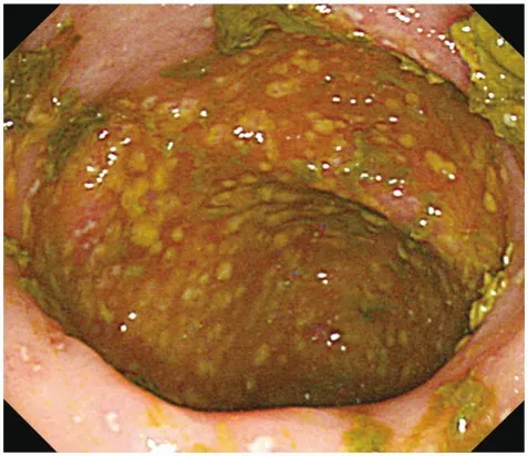 Endoscopic view of pseudomembranous colitis