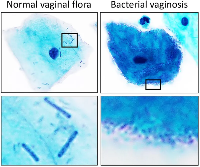 Normal vaginal flora vs. bacterial vaginosis microscopy