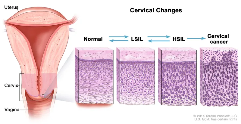 Cervical Changes: Normal to Cancer Progression