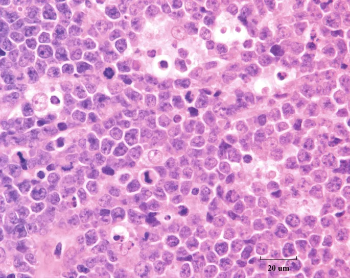 Burkitt Lymphoma: Starry Sky Pattern