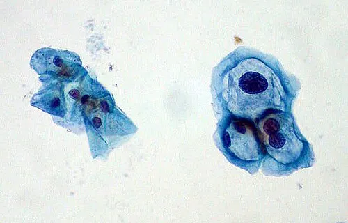 Koilocytes on Pap smear showing perinuclear halo