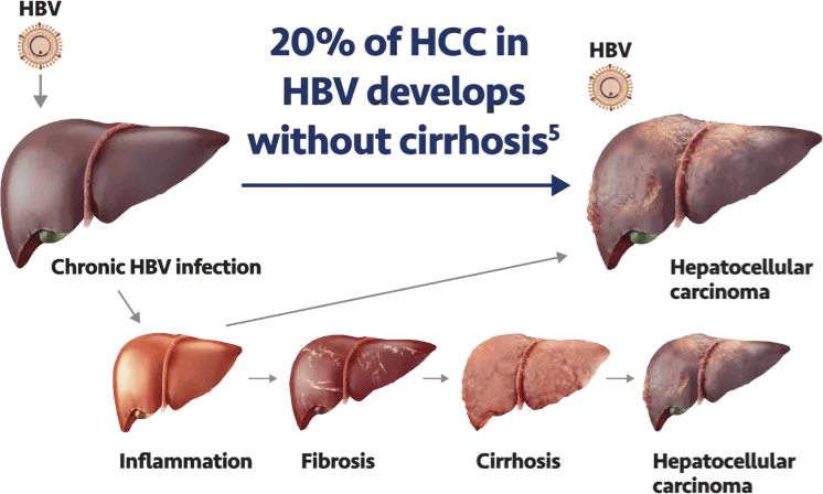 HBV and HCC Development Pathways