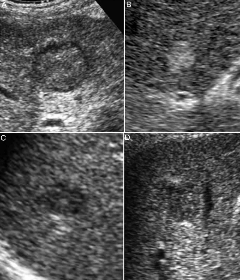 Ultrasound of liver with hepatocellular carcinoma nodules