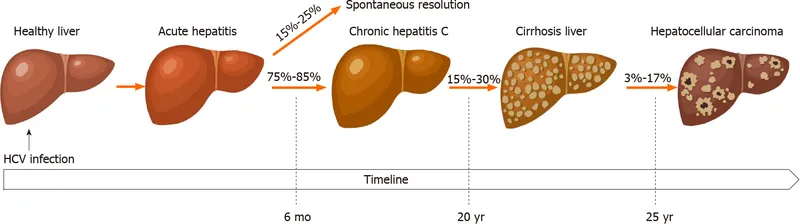 HCV infection progression to hepatocellular carcinoma