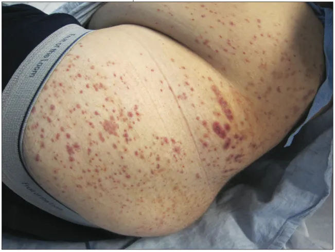 Cutaneous vasculitis with palpable purpura