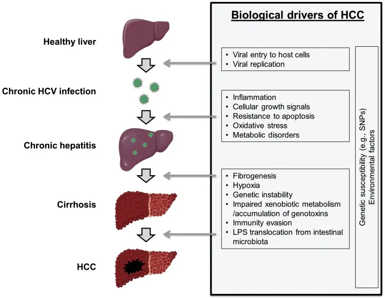 HCV-induced HCC progression and biological drivers