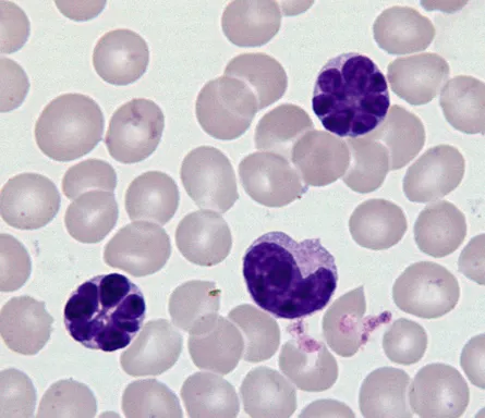 Peripheral blood smear with "flower cells" in ATLL