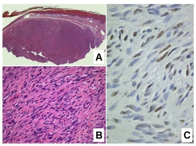 Kaposi Sarcoma Histopathology with HHV-8 IHC