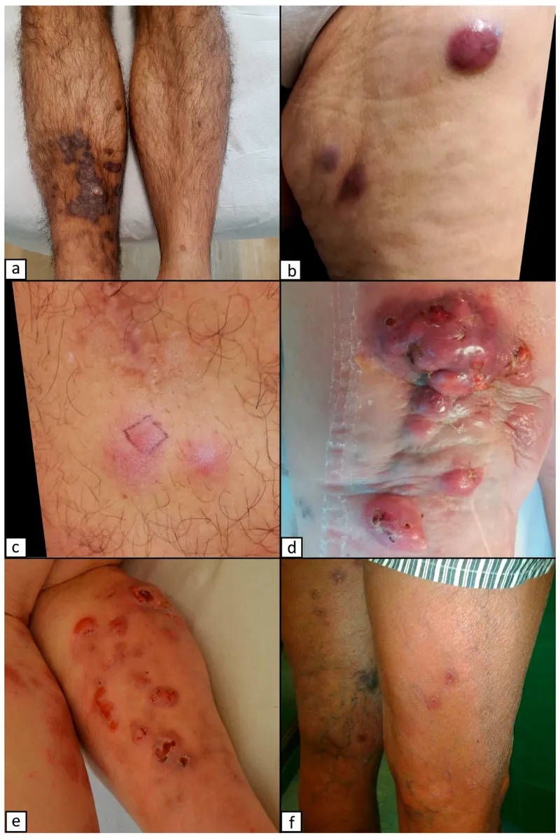 Kaposi sarcoma skin lesions: diverse presentations