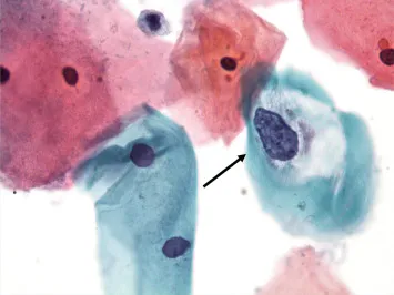 Koilocytes in cervical smear (HPV infection)