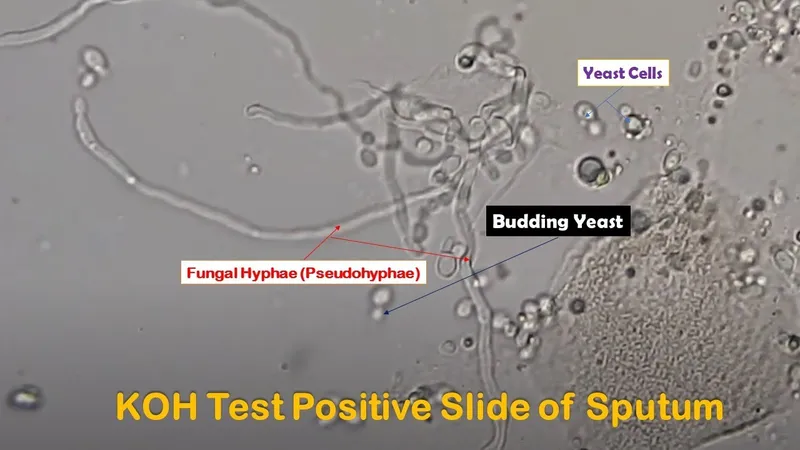 KOH prep of Candida albicans showing pseudohyphae and yeast