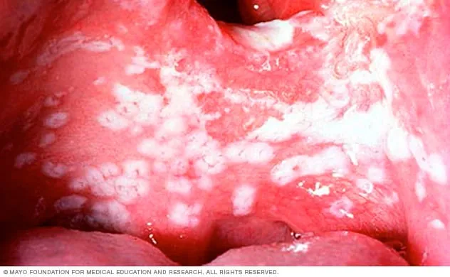 Oropharyngeal candidiasis (thrush)