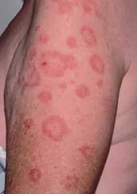 Tinea corporis lesions on arm