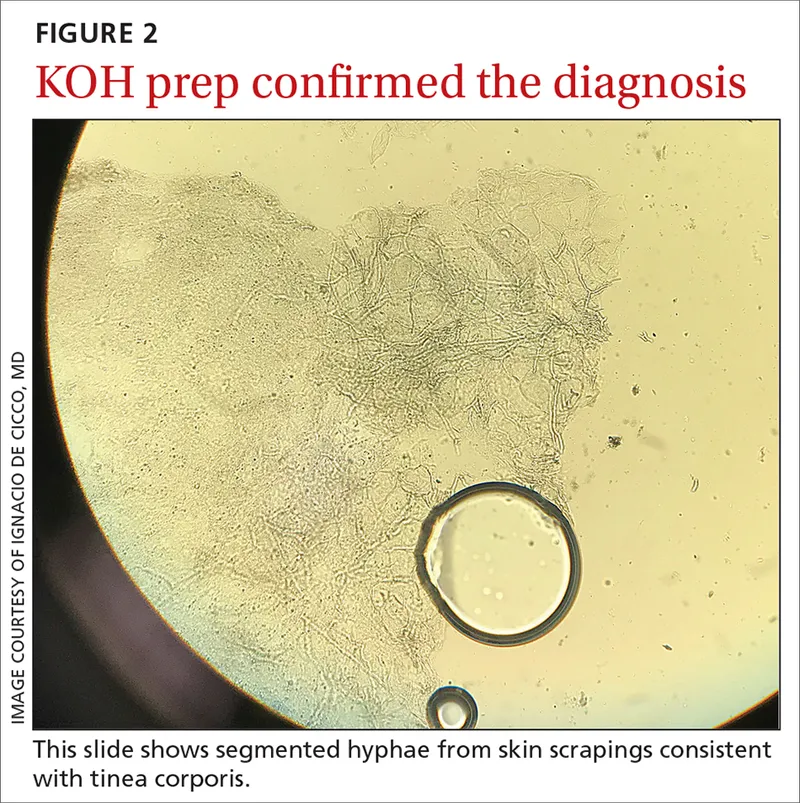 KOH prep of skin scraping showing dermatophyte hyphae