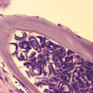 Onchocerca volvulus microfilariae in skin biopsy