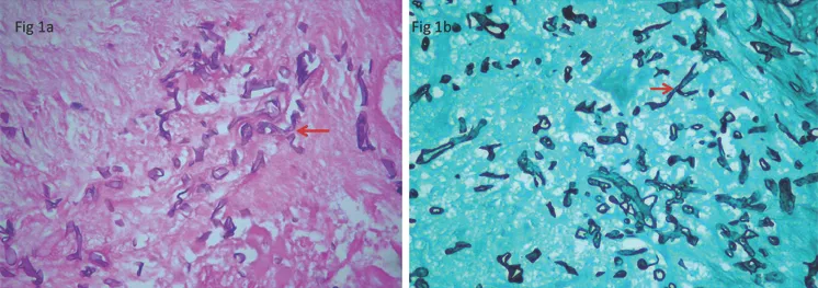 Mucormycosis histology: H&E and GMS stains