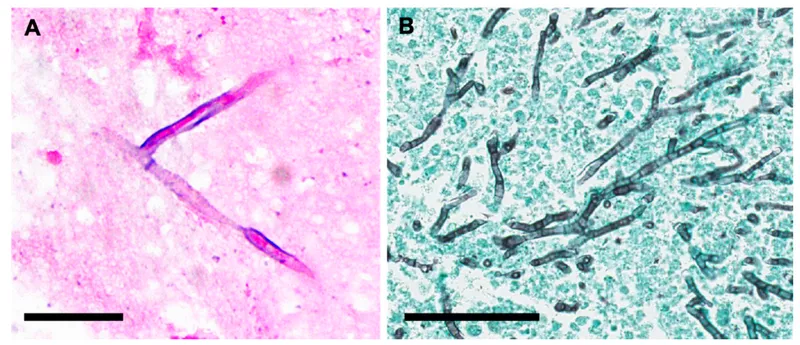 Aspergillus hyphae in tissue (H&E and GMS stains)