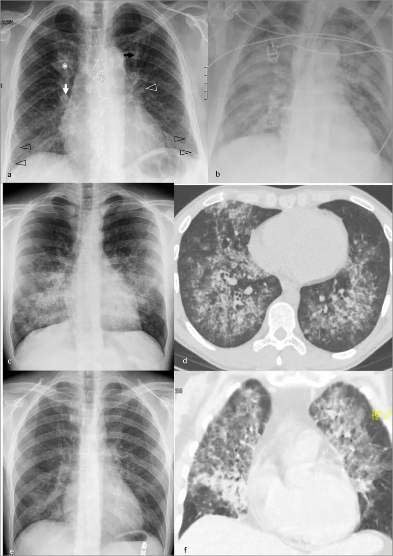 Chest X-ray and CT of Pneumocystis pneumonia