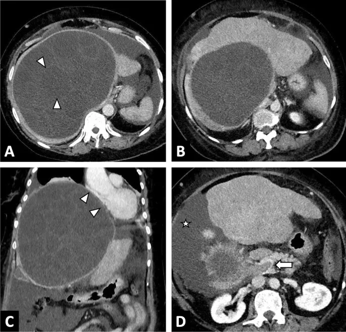 Echinococcus granulosus hydatid cyst CT scan