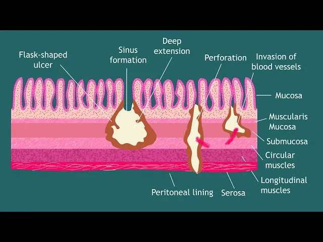 Entamoeba histolytica flask-shaped ulcer diagram