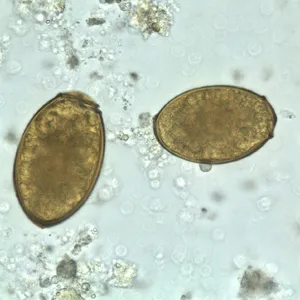 Paragonimus westermani eggs in sputum