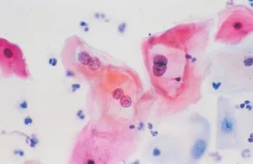 Koilocytes with perinuclear halos in HPV infection