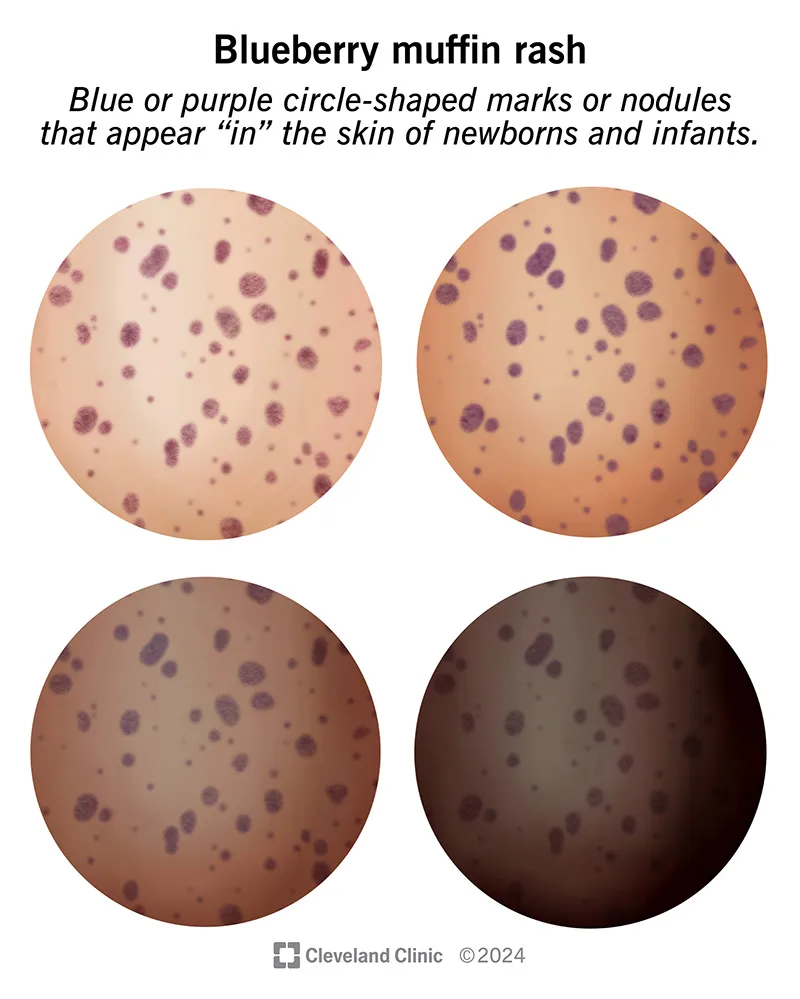 Blueberry muffin rash on different skin tones