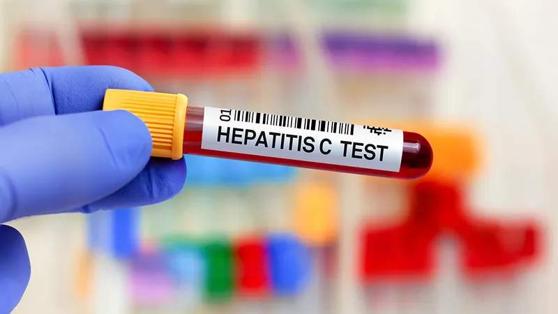 Hepatitis C Test