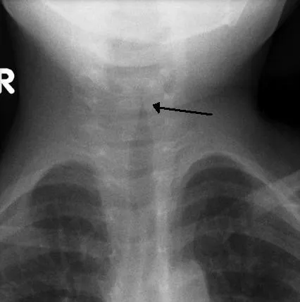 Chest X-ray: Steeple sign in croup