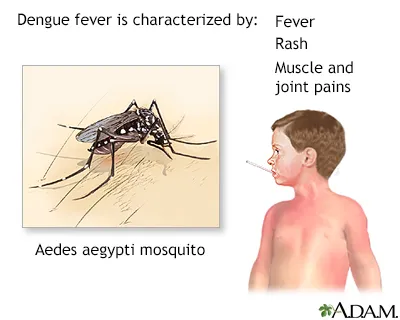 Dengue Fever: Aedes aegypti mosquito and symptoms