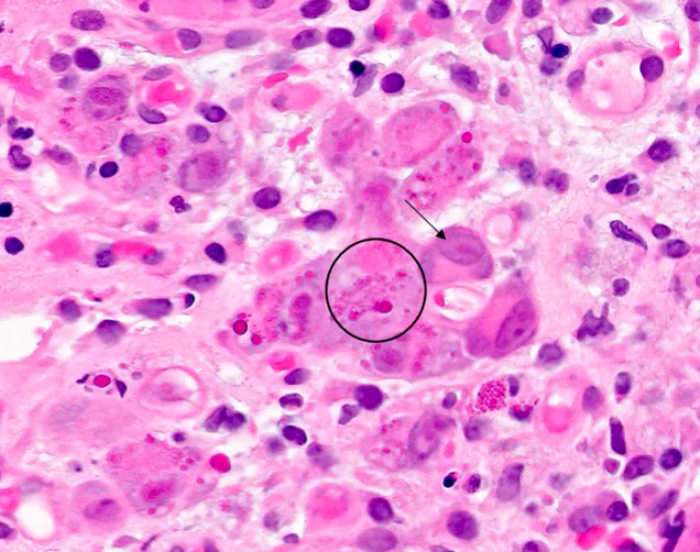 CMV owl's eye inclusion bodies in histology