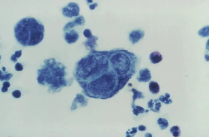 Tzanck smear: multinucleated giant cells in HSV infection