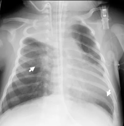 Chest X-ray: RSV bronchiolitis with hyperinflation